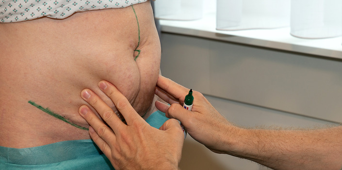 erschlaffter_Bauch_wird_angezeichnet (1)