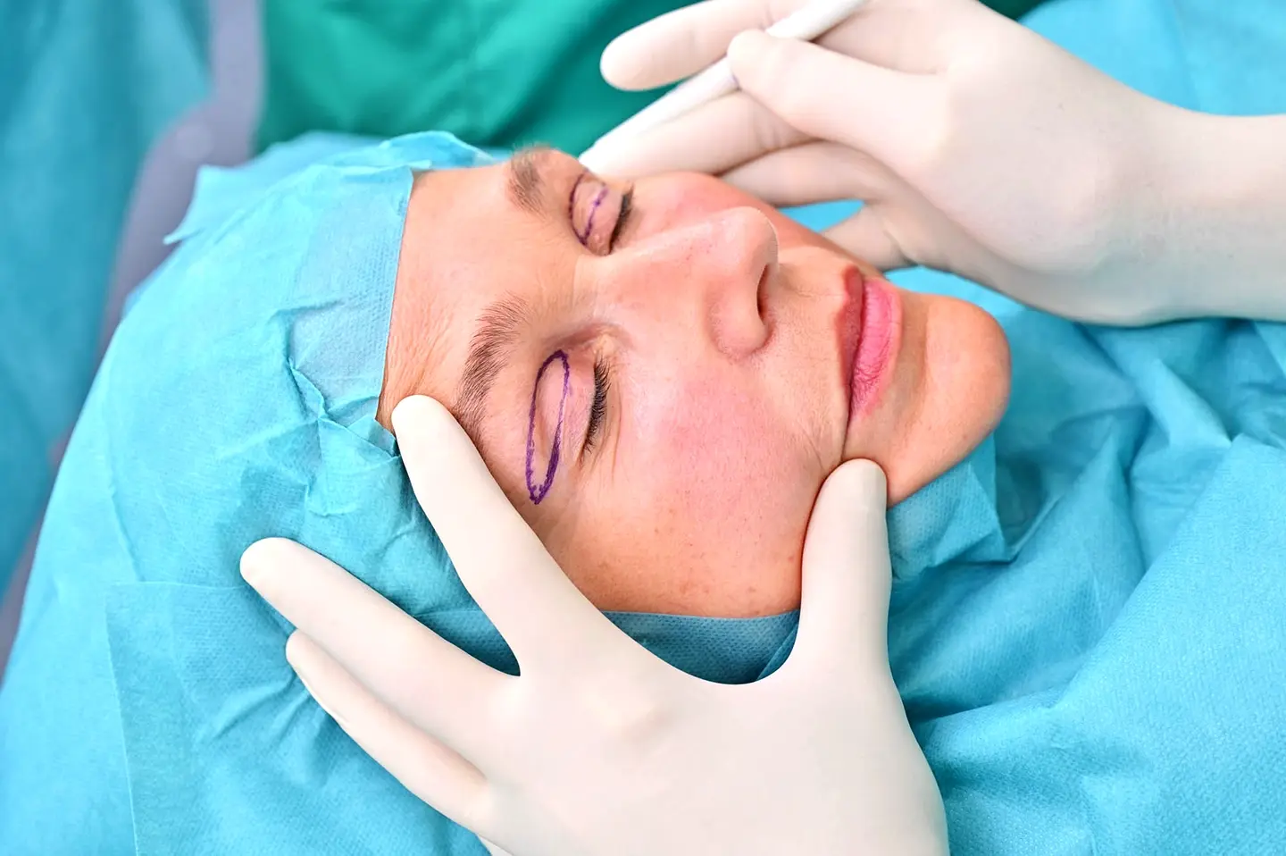 Oberlidstraffung vorher nachher