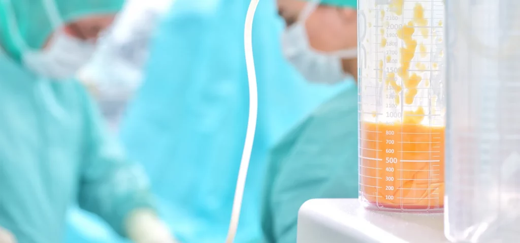 Fettabsaugung vorher-nachher