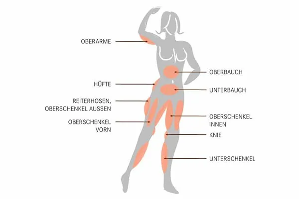 Fettabsaugung - Behandlungsareale bei Frauen und Männern