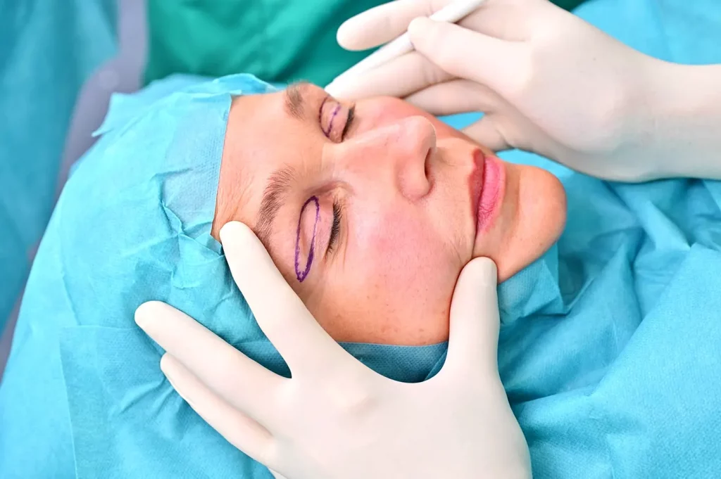 oberlidstraffung vorher-nachher