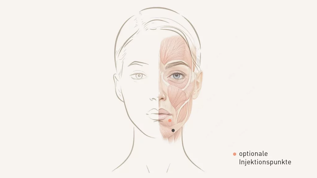 Injektionsschema M.-Depressor-anguli-oris