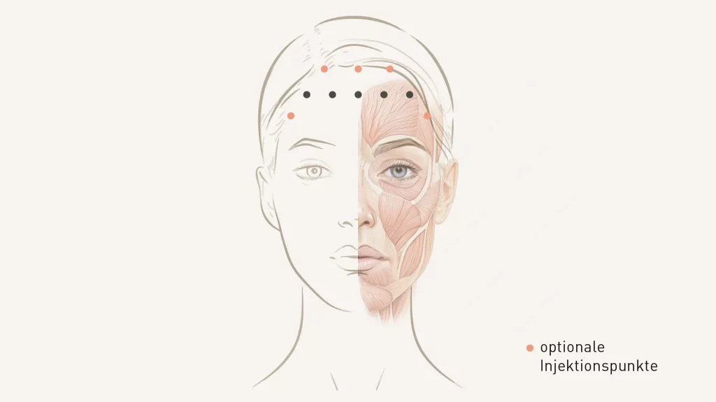 Injektionsschema Stirn
